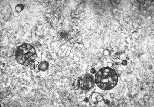 F,25y. | myopathy - atrophic and regenerating muscle cells